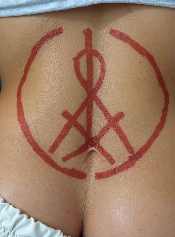 buttock-scarring-after-judicial-caning-pegjzaepke