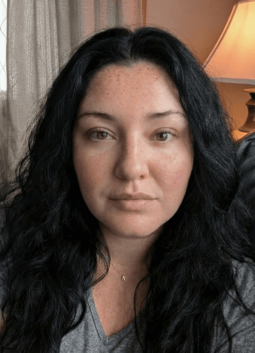 remove-bags-under-eyes-and-deep-lines-hyper-t87tk5274u